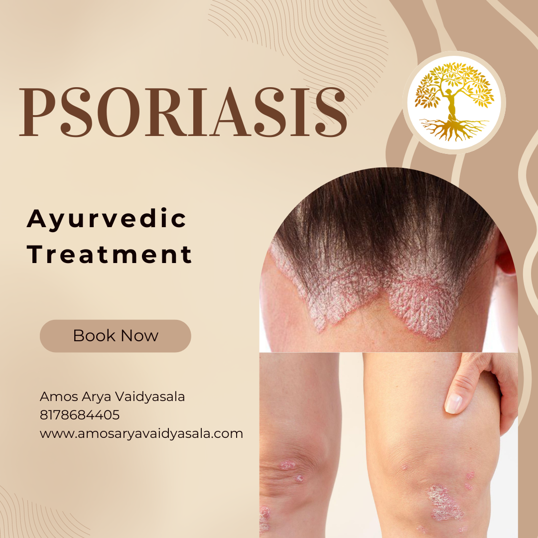 Psoriasis Ayurvedic treatment  in Delhi